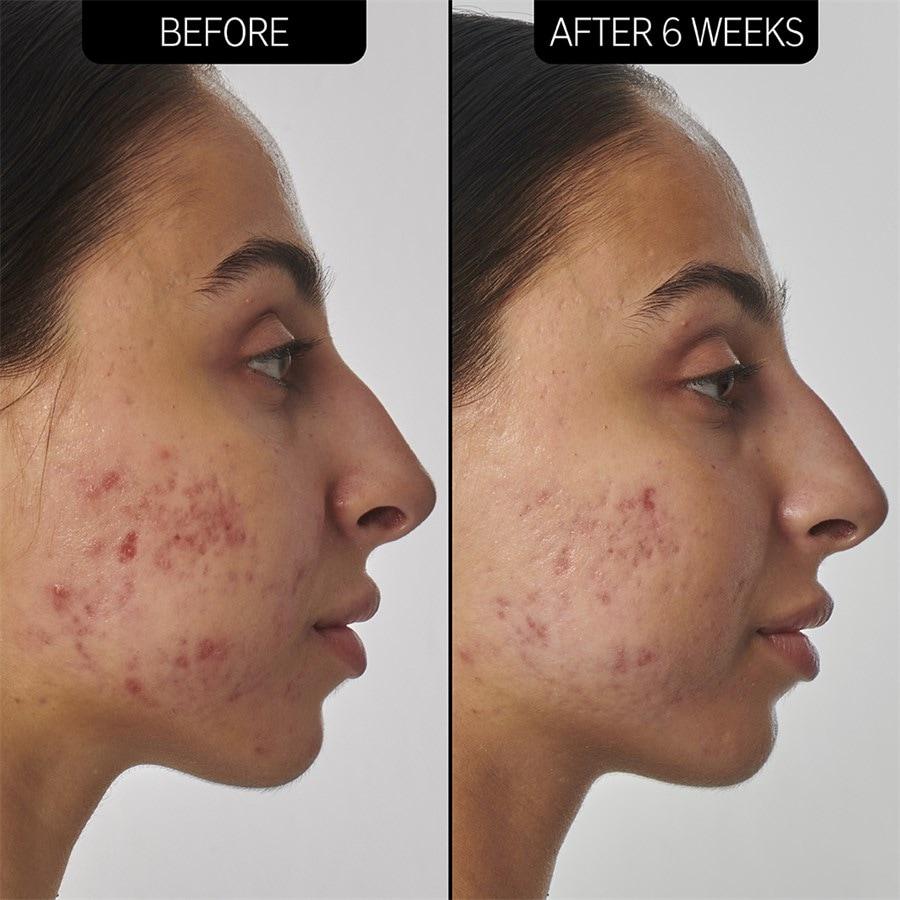 The INKEY List Sieri SuperSolutions 1% Retinol Serum Presa