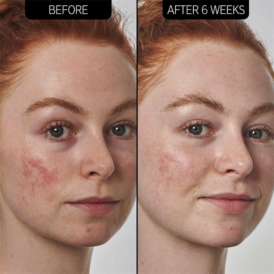 The INKEY List Sieri SuperSolutions 10% Azelaic Acid Serum Negozi Online